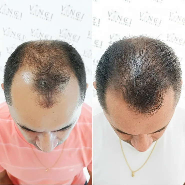 Antes e depois de Rodrigo Sousa: à esquerda, entradas e coroa rala; à direita, topo mais preenchido.