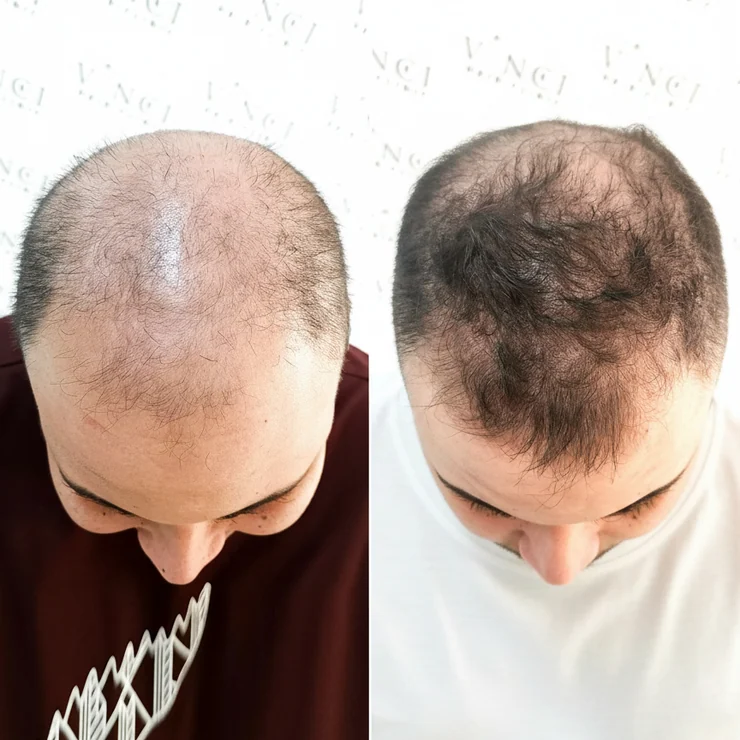 Antes e depois de Alessandro Jesus: à esquerda, topo quase sem cabelo; à direita, fios mais densos cobrindo o couro cabeludo.