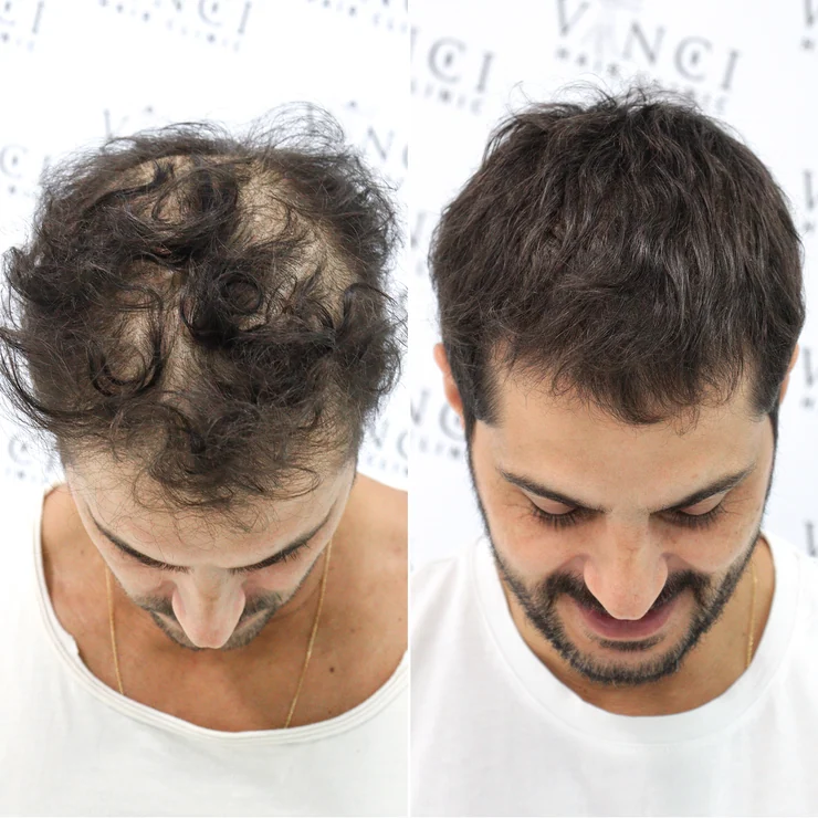 Antes e depois de Hugo Rodrigues: à esquerda, fios finos e falhas no topo; à direita, cabelo mais cheio e volumoso.